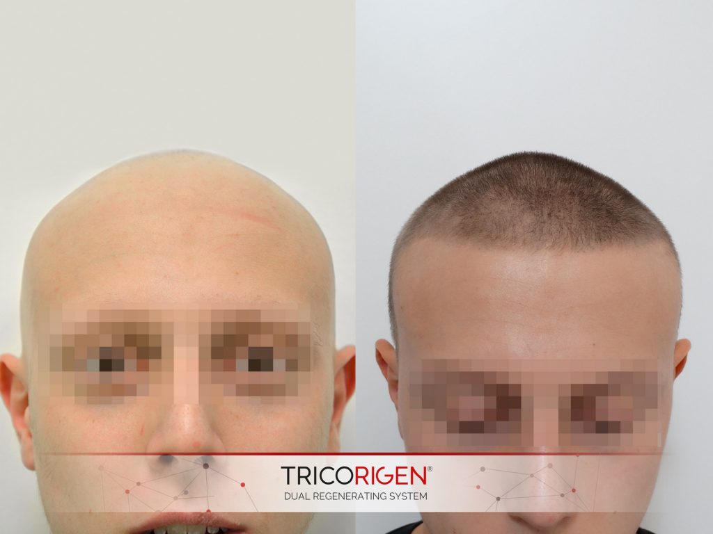 tratament alopecie totala tricopigmentarea